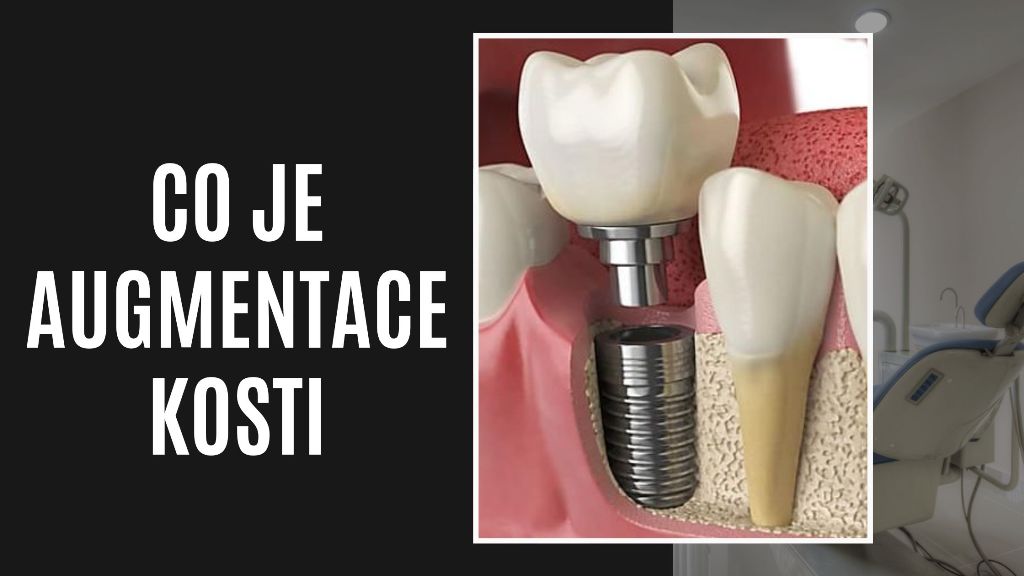 Co Je Augmentace Kosti