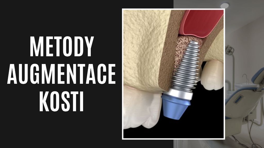 Metody Augmentace Kosti
