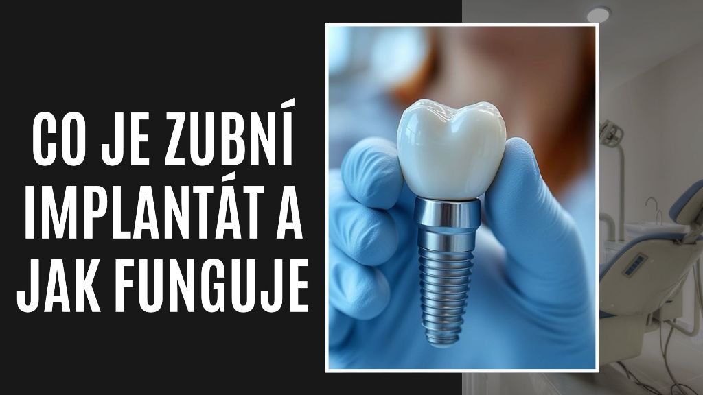 Co Je Zubní Implantát a Jak Funguje