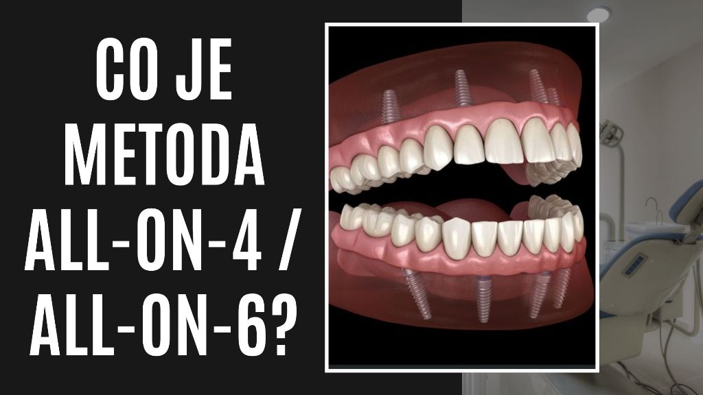 Co je metoda All-on-4 _ All-on-6