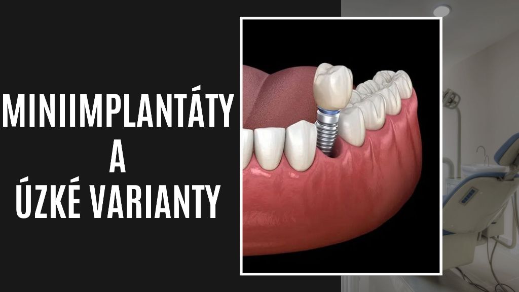 Miniimplantáty a úzké varianty