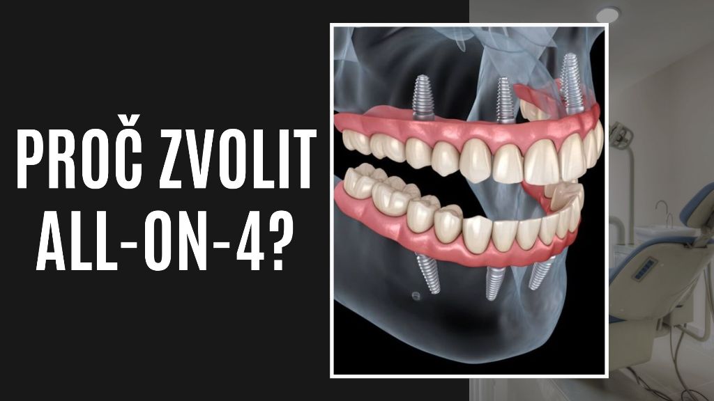 Proč zvolit All-on-4