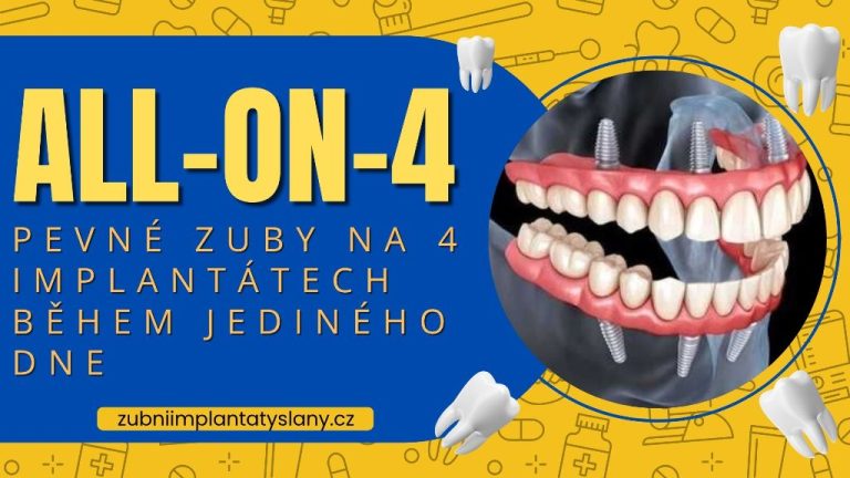 All-on-4_ Pevné zuby na 4 implantátech během jediného dne