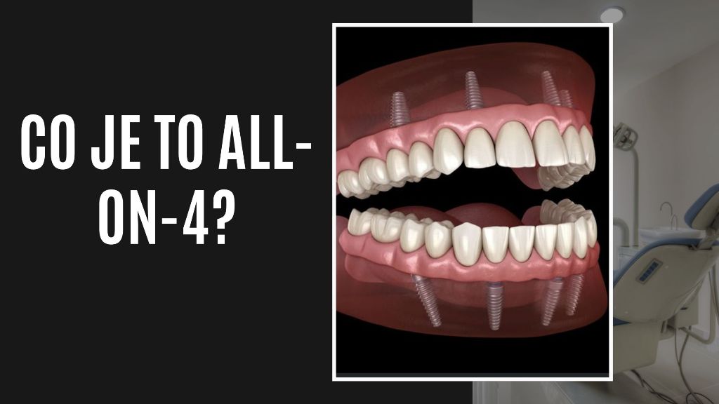 Co je to All-on-4