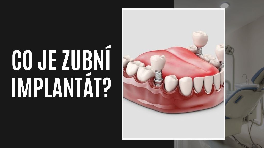 Co je zubní implantát