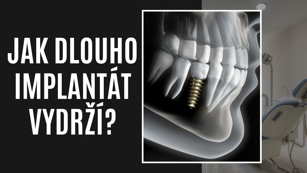 Jak dlouho implantát vydrží