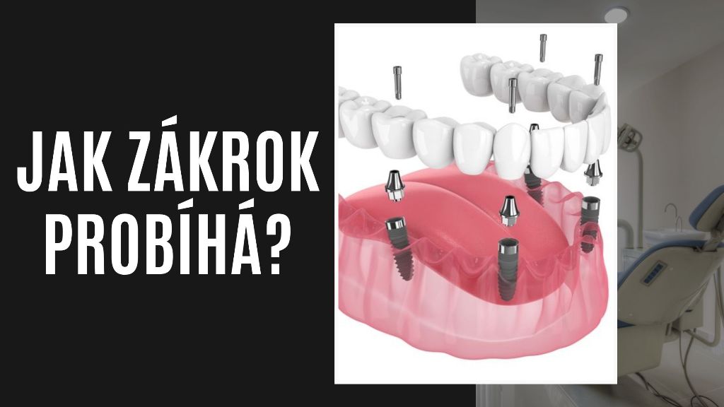 Jak zákrok probíhá