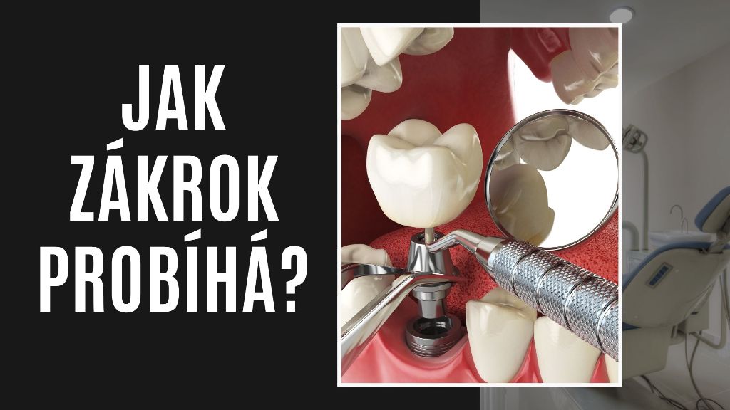 Jak zákrok probíhá