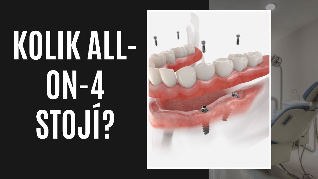 Kolik All-on-4 stojí