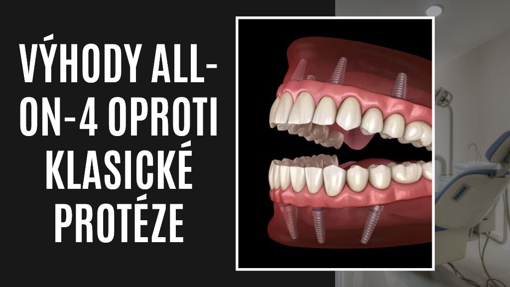 Výhody All-on-4 oproti klasické protéze