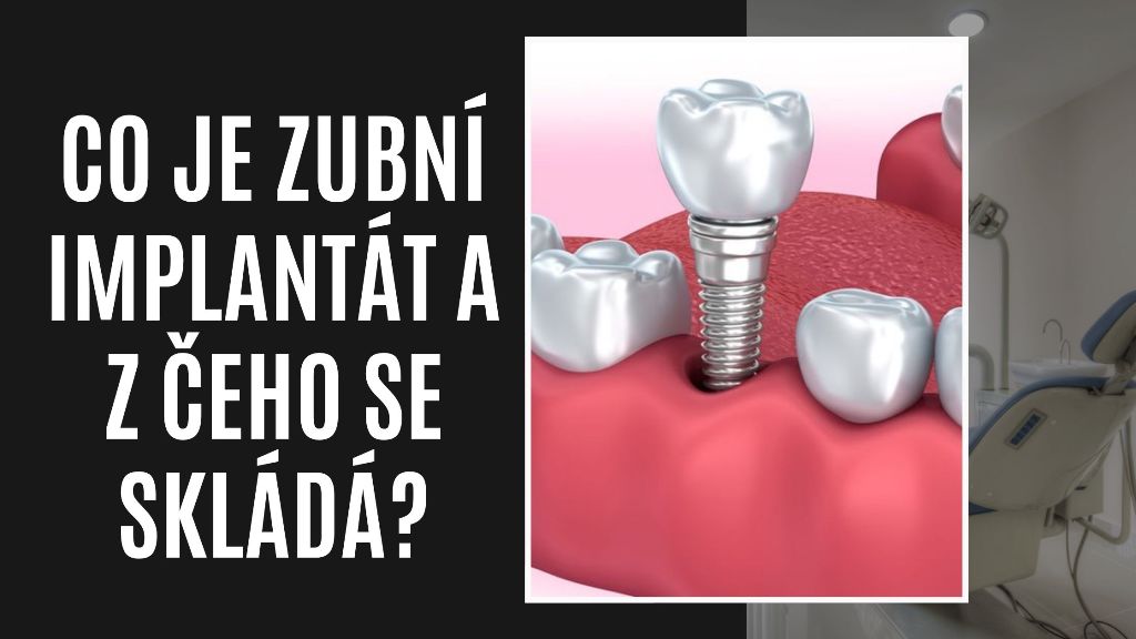 Co je zubní implantát a z čeho se skládá