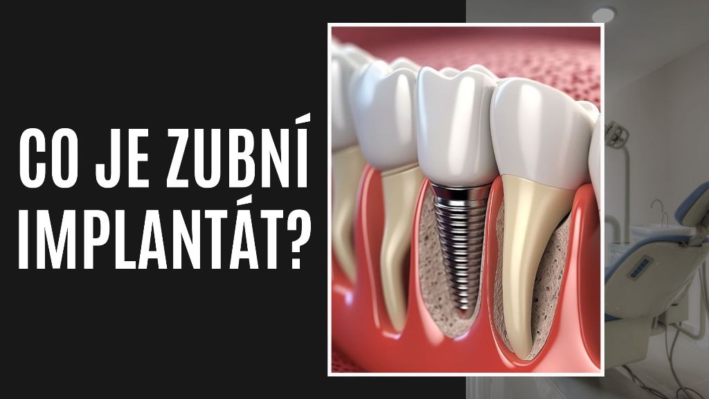 Co je zubní implantát?