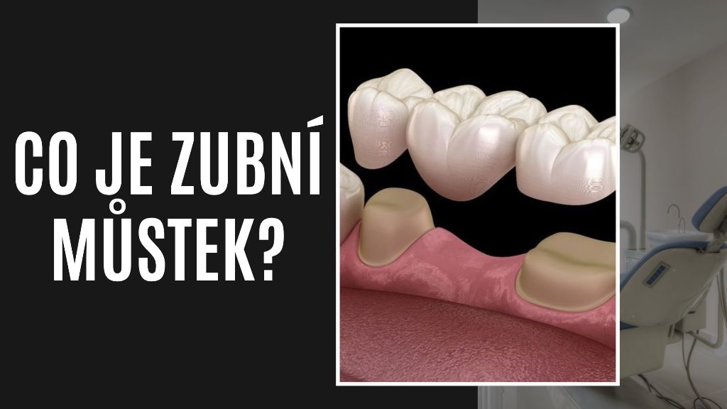 Co je zubní můstek?