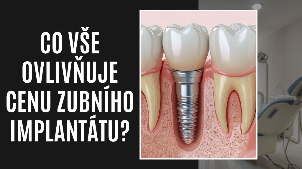 Co vše ovlivňuje cenu zubního implantátu
