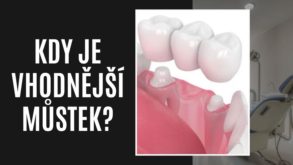 Kdy je vhodnější můstek