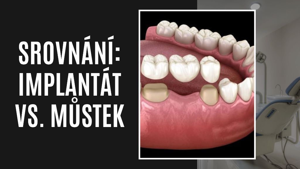 Srovnání_ Implantát vs. můstek