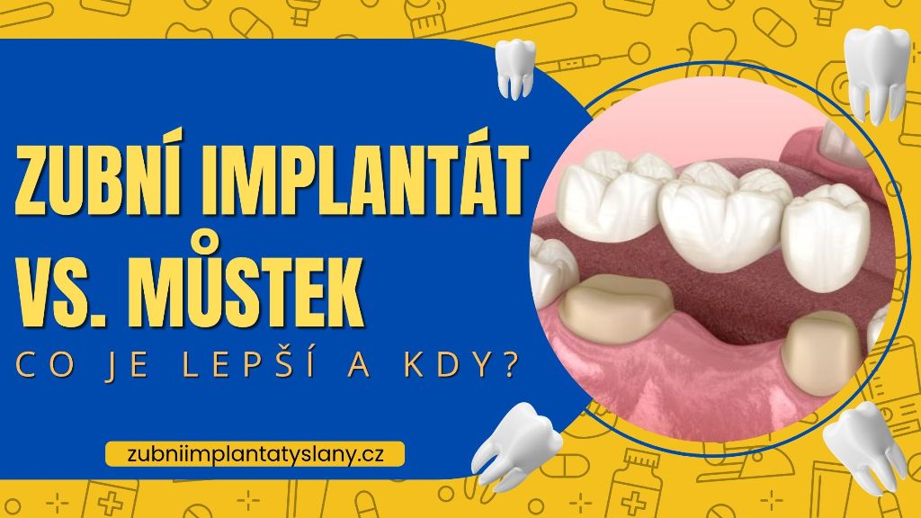 Zubní implantát vs. můstek_ Co je lepší a kdy
