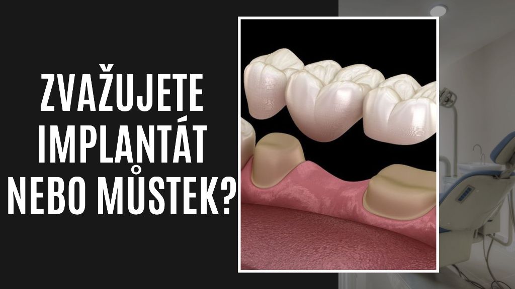 Zvažujete implantát nebo můstek